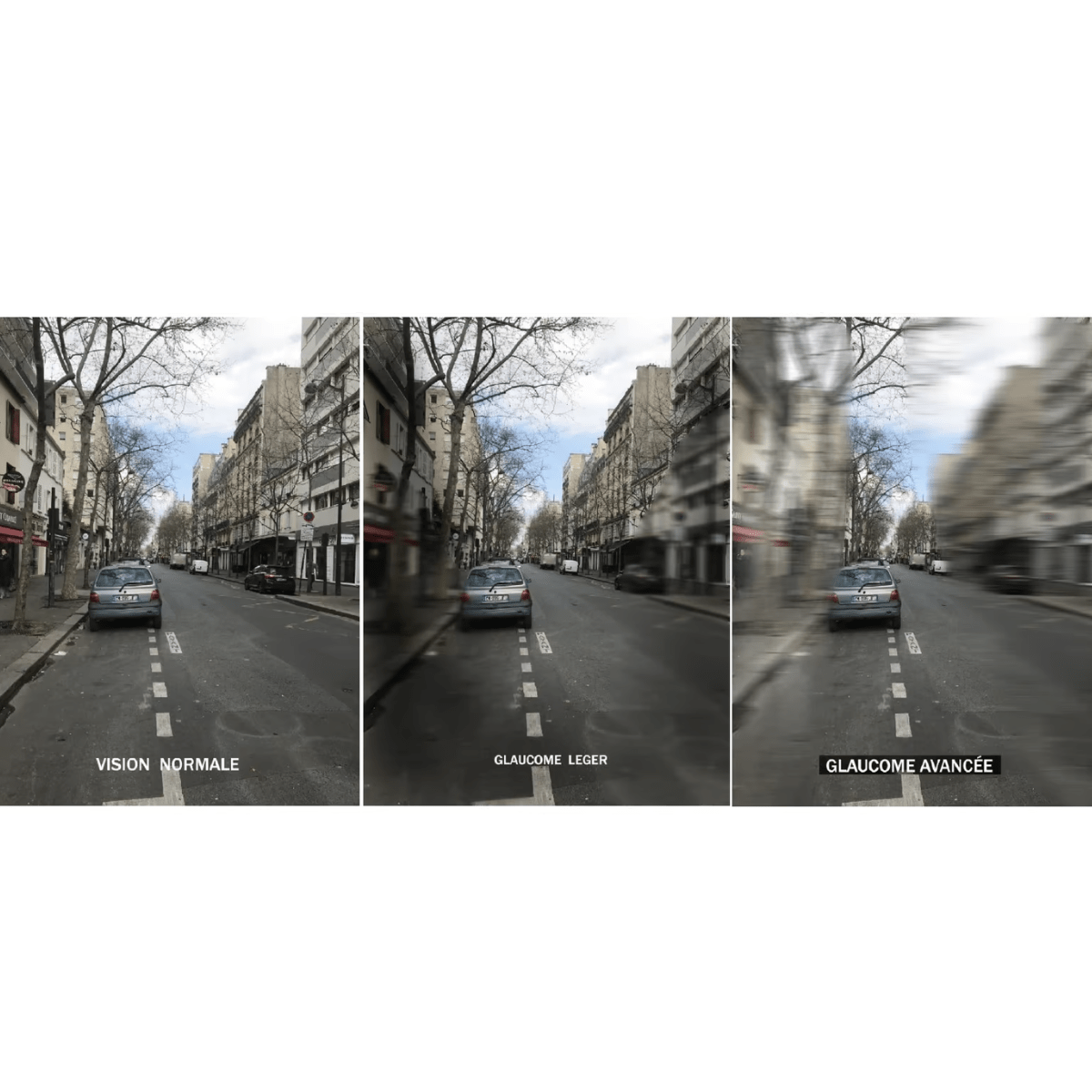 Quels sont les différents types de déficiences visuelles